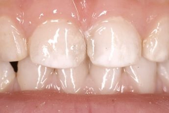 Как бороться с белыми пятнами на зубах