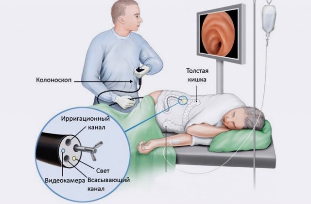 Колоноскопия : что это, подготовка к процедуре, диета, ‍⚕️ как делают ...