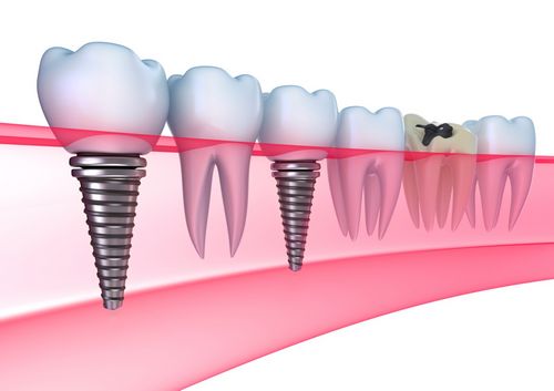 Имплантация зубов – роскошь или необходимость? 