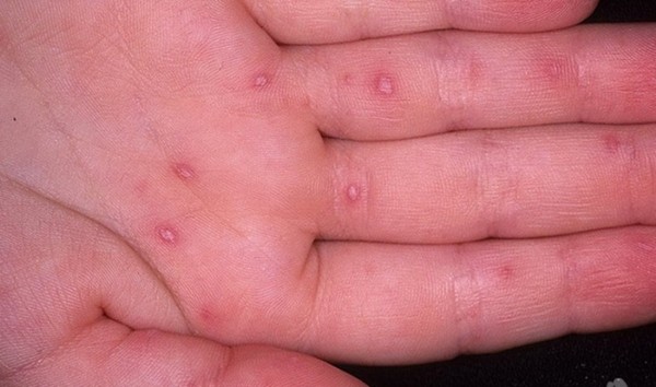 Сыпь у взрослых: фото, причины возникновения сыпи и советы по лечению кожных высыпаний
