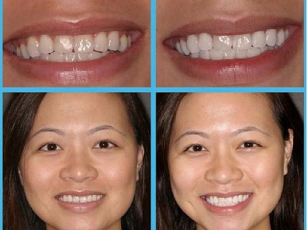 отбеливание зубов в стоматологии сколько держится