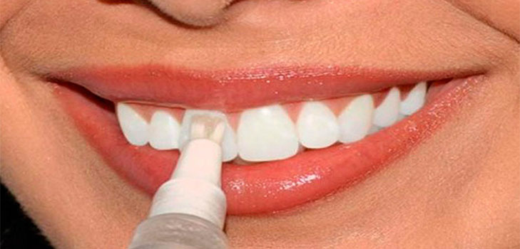 Эффективное отбеливание зубов в домашних условиях