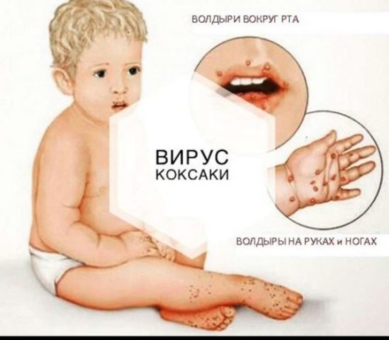 Вирус Коксаки: чем опасен, симптомы и лечение у детей и взрослых, фото