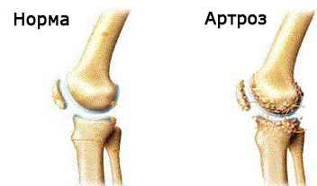 Лечение народными средствами артроза коленного сустава