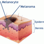 Меланома кожи